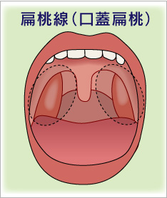 扁桃腺の場所_扁桃腺摘出手術