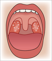 扁桃腺の性病の症状_クラミジア_淋病