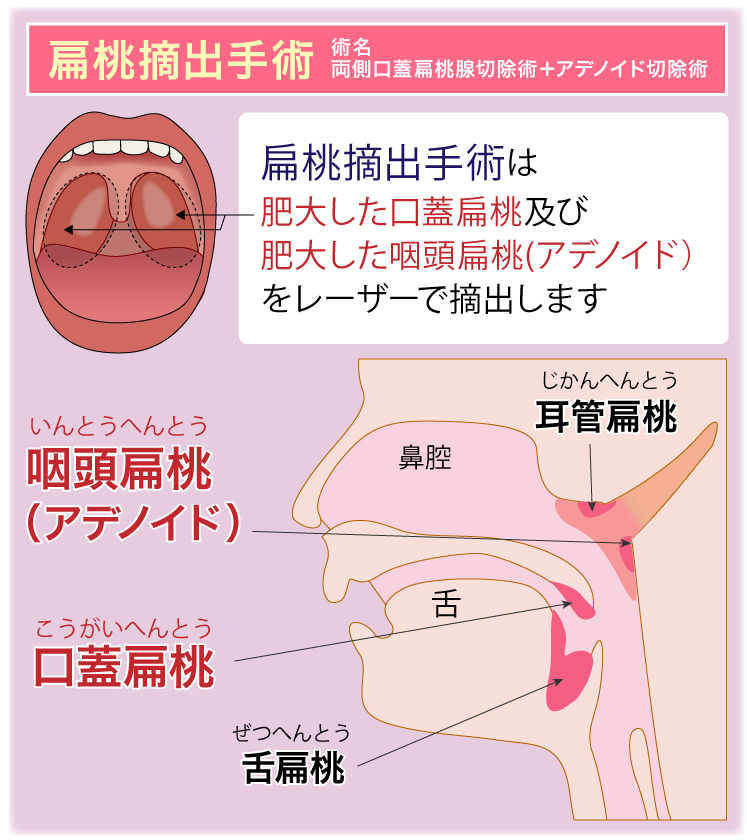 扁桃線 摘出 手術