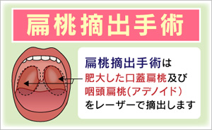 扁桃腺の場所_扁桃腺摘出手術